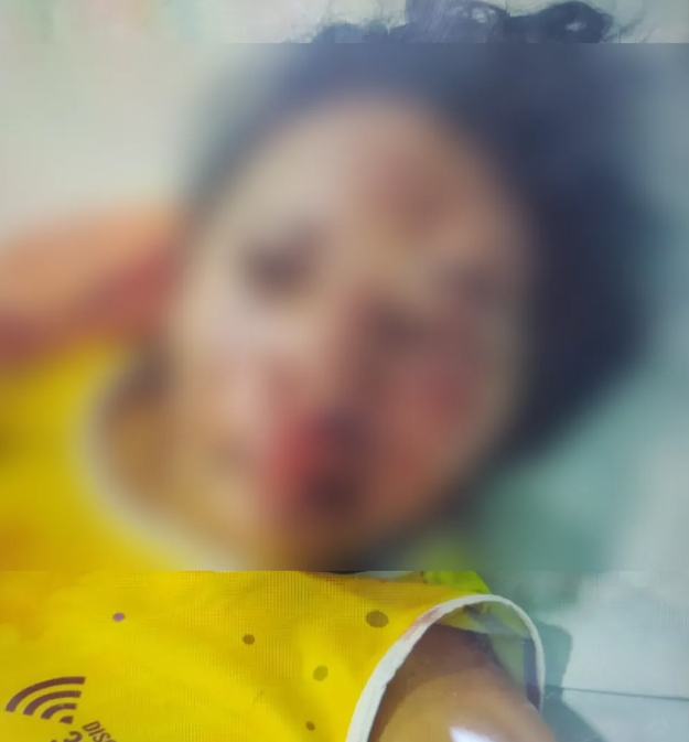 Mulher é espancada e sofre afundamento no crânio após recusar sexo durante festa